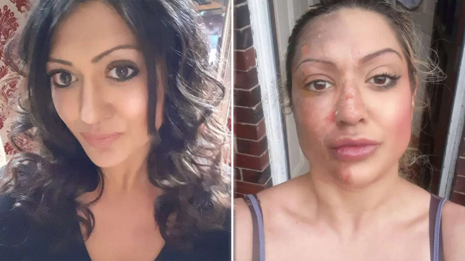womans-face-burned-after-tiktok-egg-poaching-hack