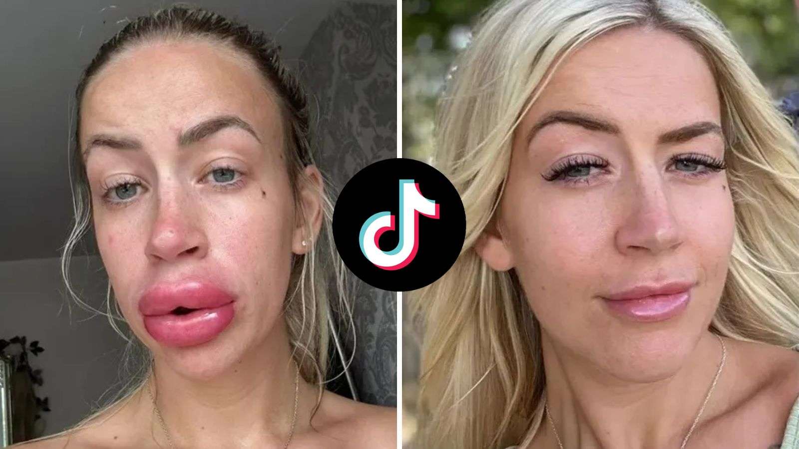 Woman with huge swollen lips after getting lip fillers dissolved
