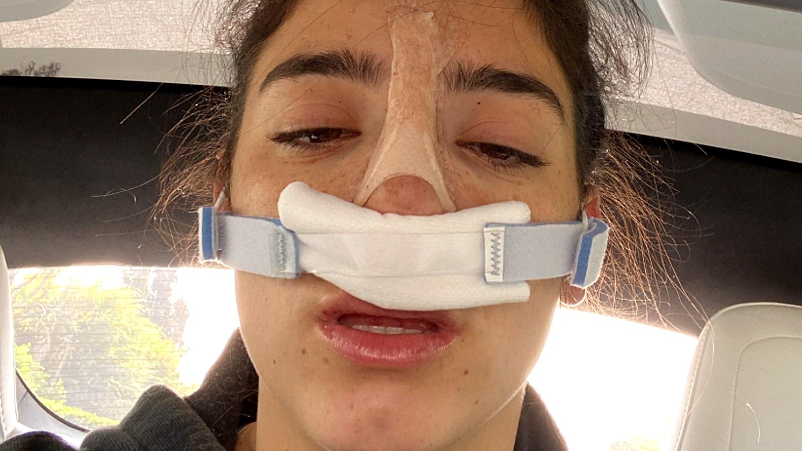 Dixie D'Amelio gets nose surgery