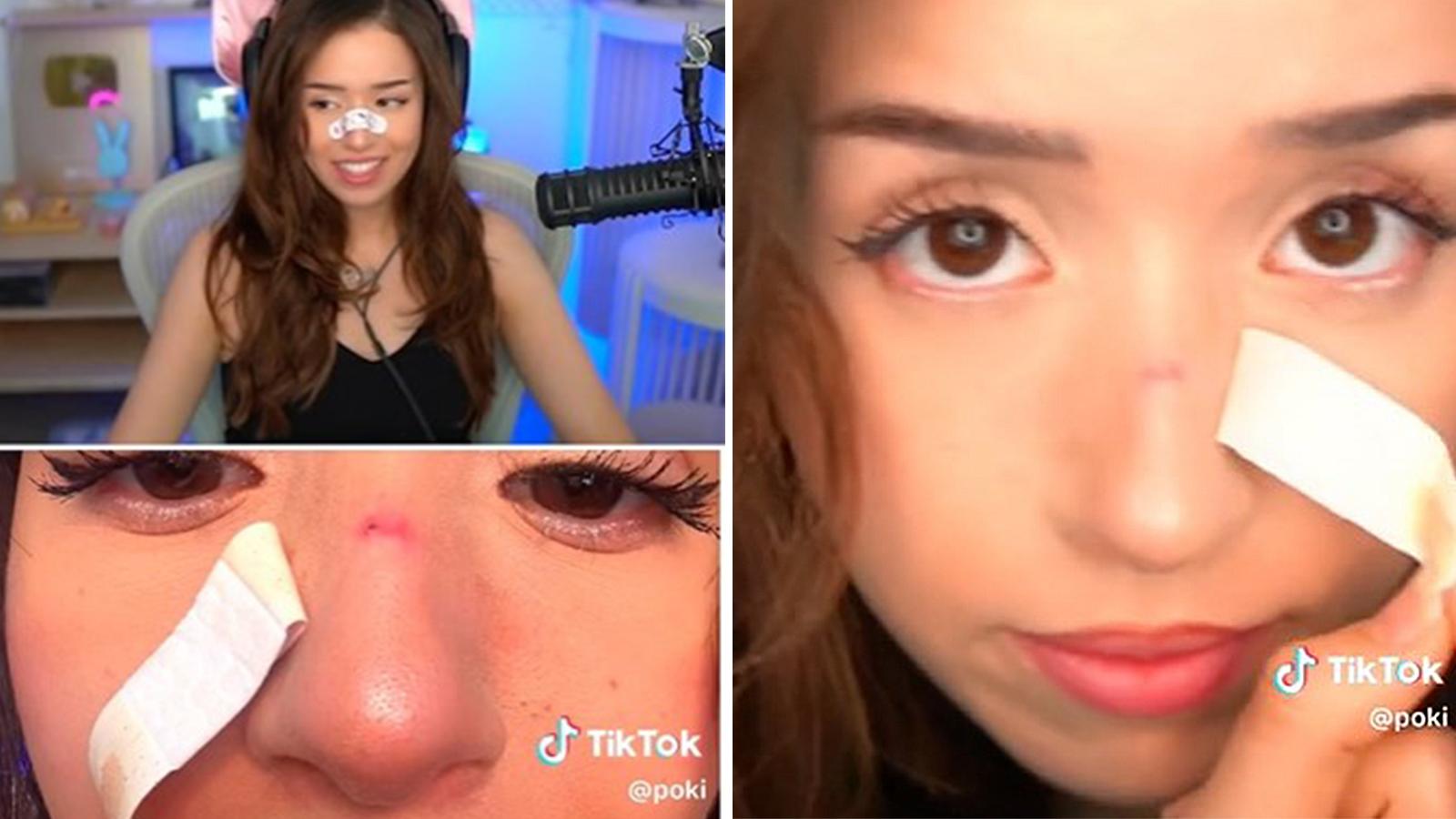 pokimane reveals nose injury after bloody laptop accident