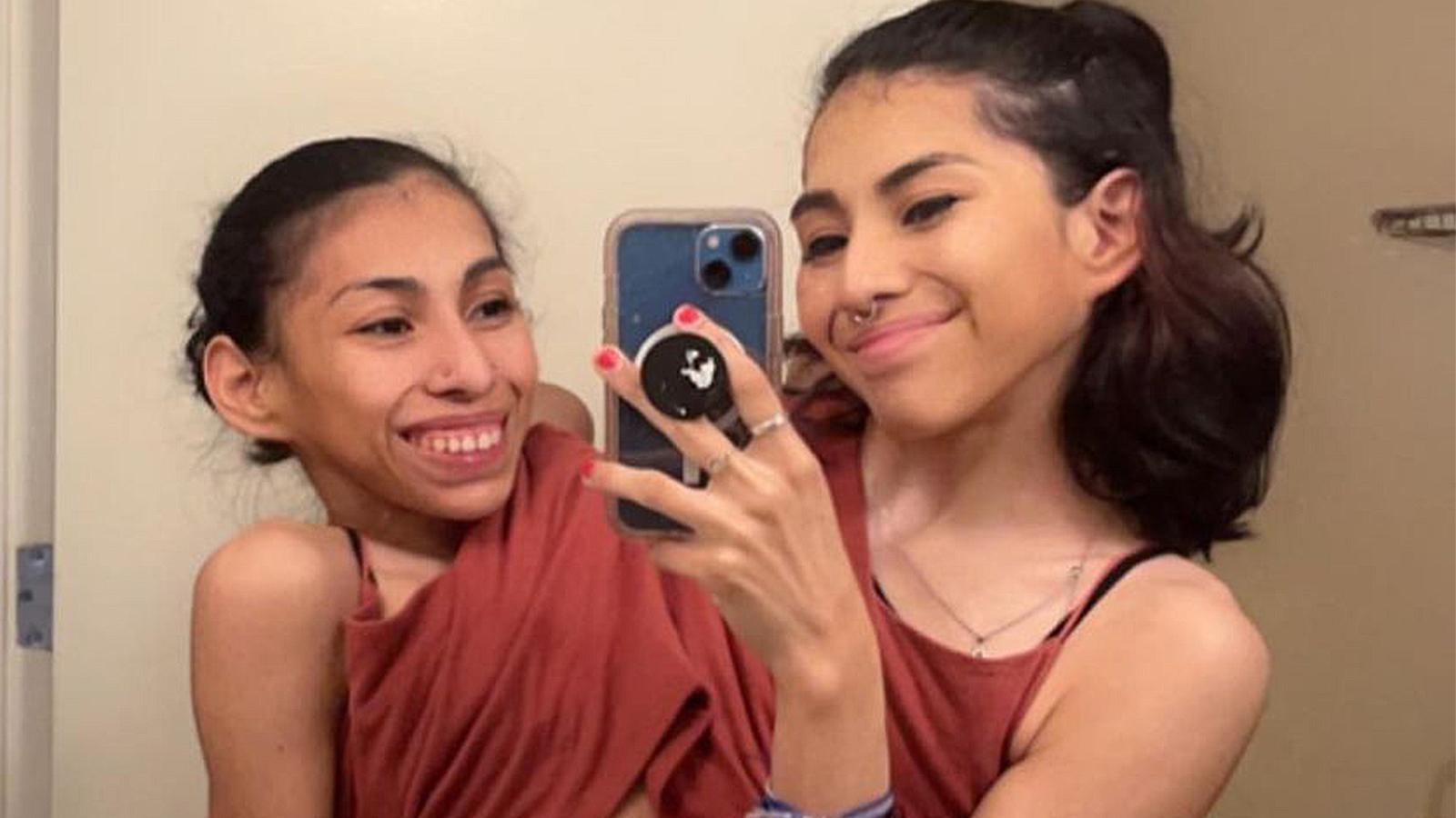 TikTok famous conjoined twins explain how their dating lives work