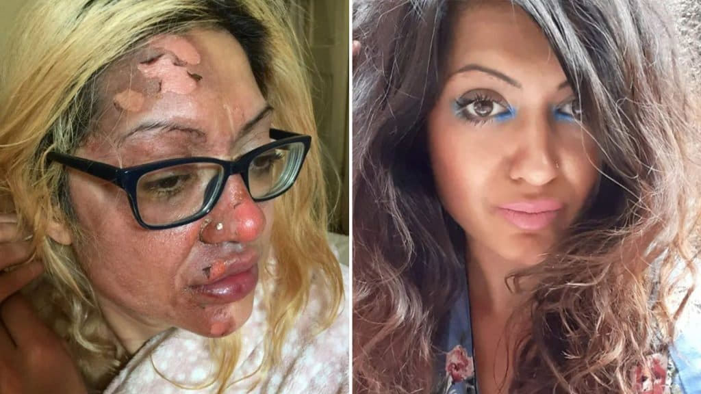 woman-suffers-facial-burns-after-exploding-egg-tiktok-hack
