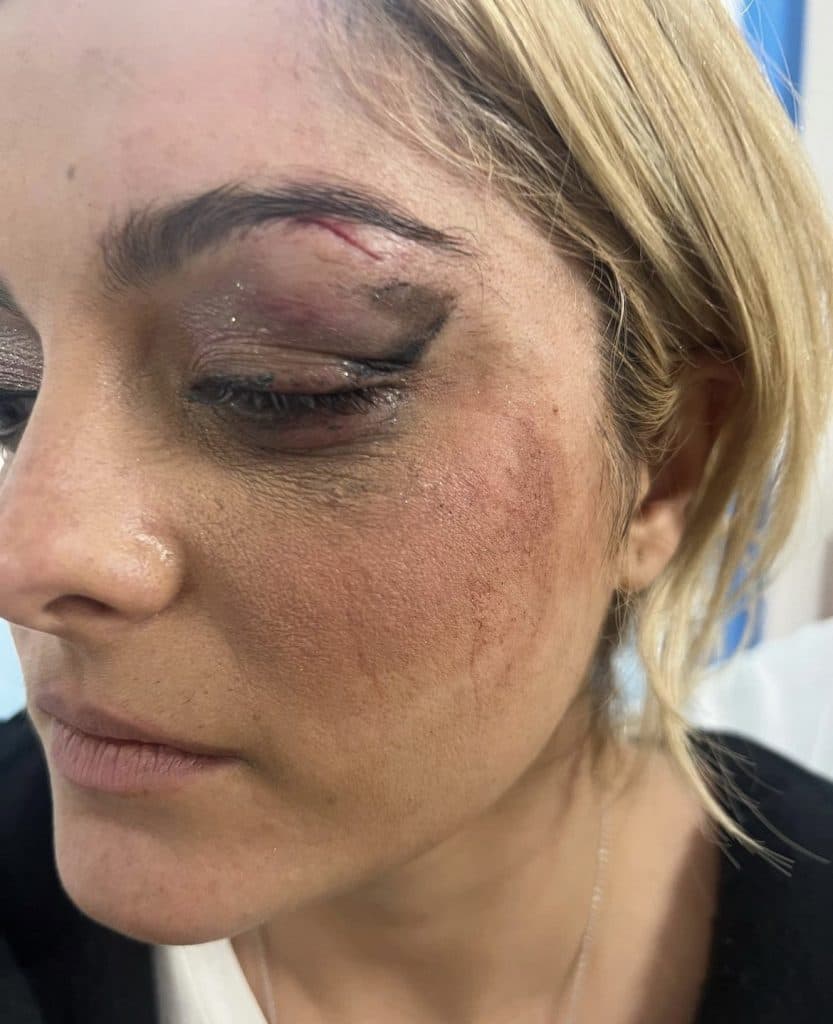 Bebe Rexha's injuries after being struck by an object while performing.