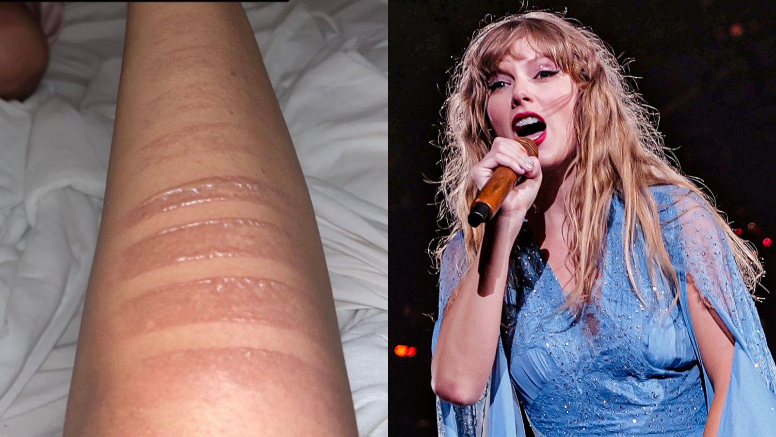 Taylor Swift fan suffered burns during concert