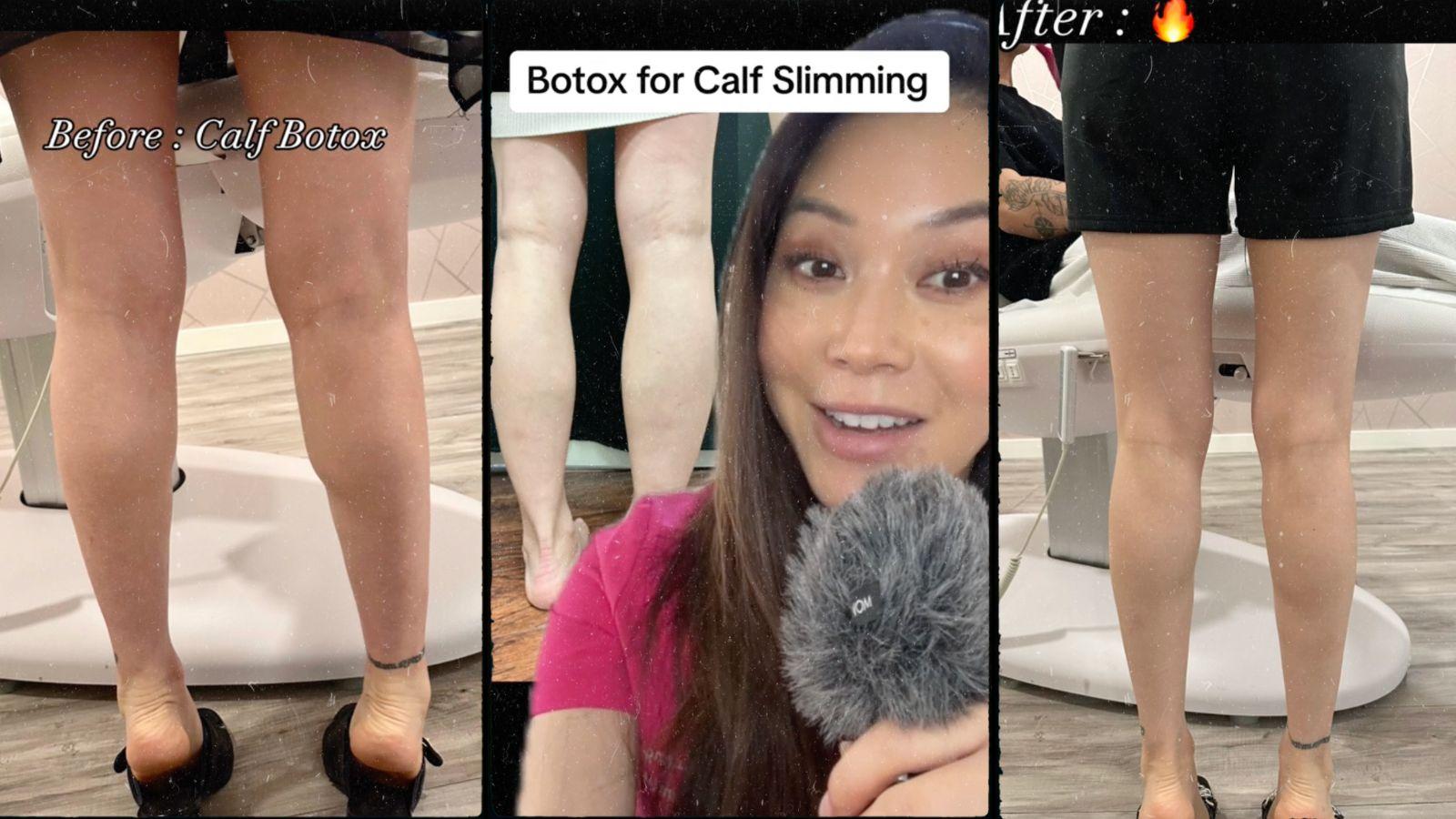 what is calf tox on TikTok